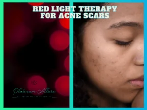 Red Light Therapy for Acne Scars